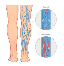 Vein & Vascular